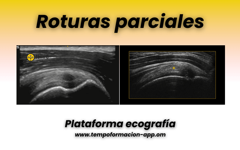 4. Tendon supraespinoso ecografia y patologia.png